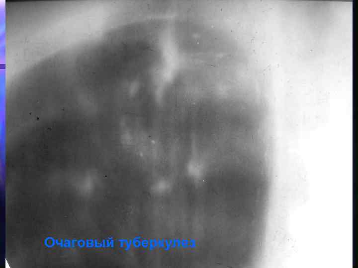 Очаговый туберкулез 