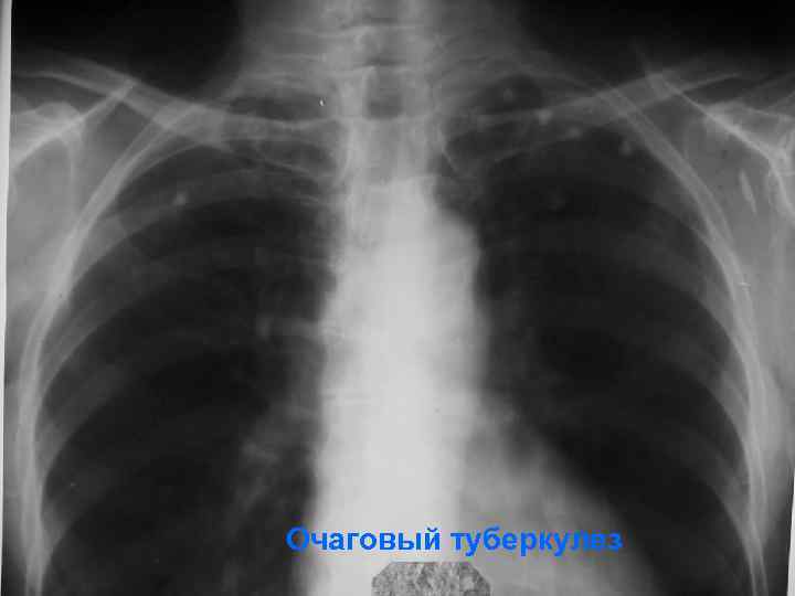 Очаговый туберкулез 