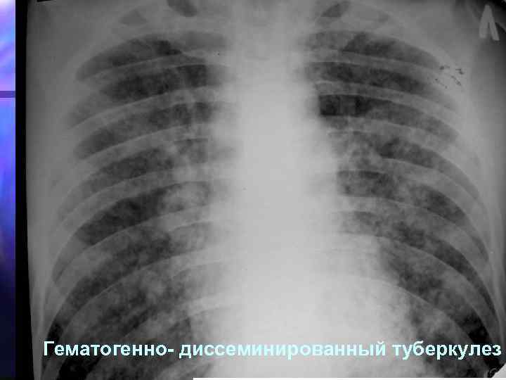 Гематогенно- диссеминированный туберкулез 