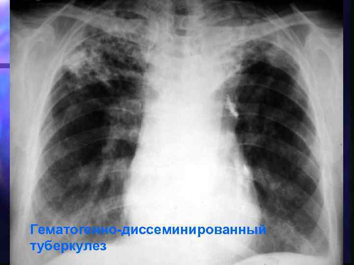 Гематогенно-диссеминированный туберкулез 