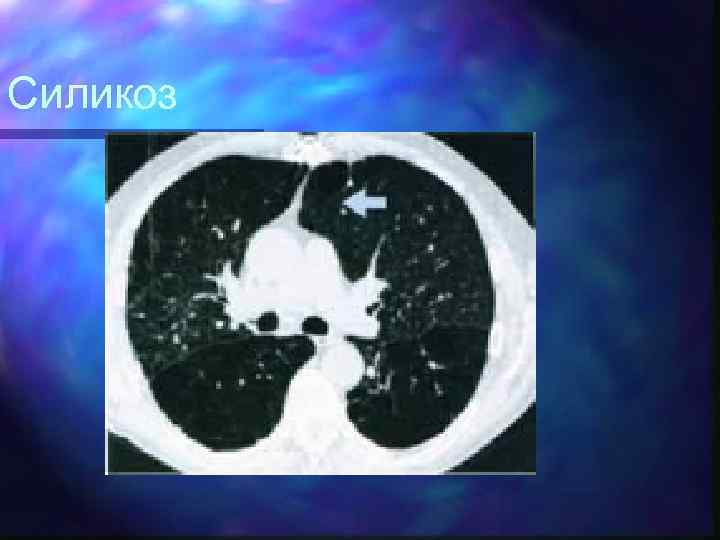 Силикоз 
