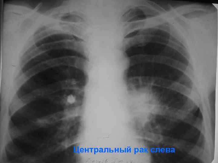 Центральный рак слева 