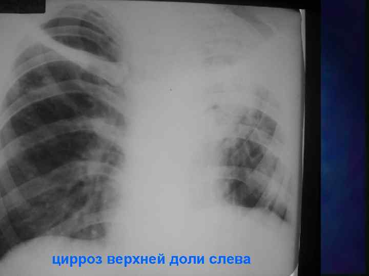 цирроз верхней доли слева 
