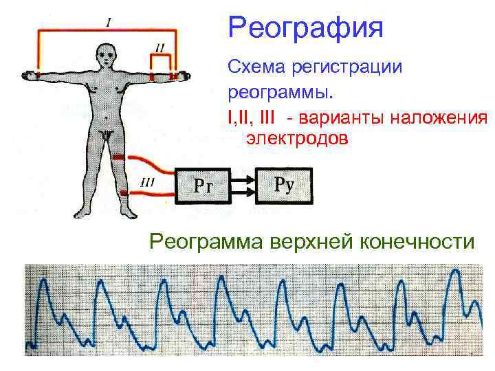 Реография Схема регистрации реограммы. I, III - варианты наложения электродов Реограмма верхней конечности 