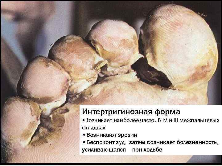 Интертригинозная форма • Возникает наиболее часто. В IV и III межпальцевых складках • Возникают