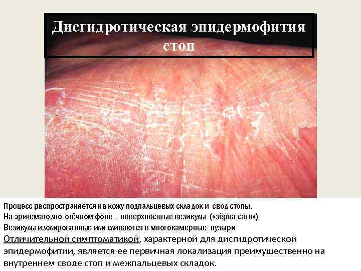 Дисгидротическая эпидермофития стоп Процесс распространяется на кожу подпальцевых складок и свод стопы. На эритематозно-отёчном