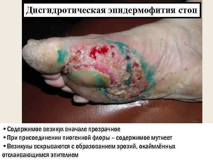 Дисгидротическая эпидермофития стоп • Содержимое везикул вначале прозрачное • При присоединении пиогенной флоры –