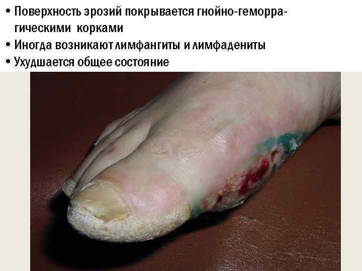  • Поверхность эрозий покрывается гнойно-геморрагическими корками • Иногда возникают лимфангиты и лимфадениты •