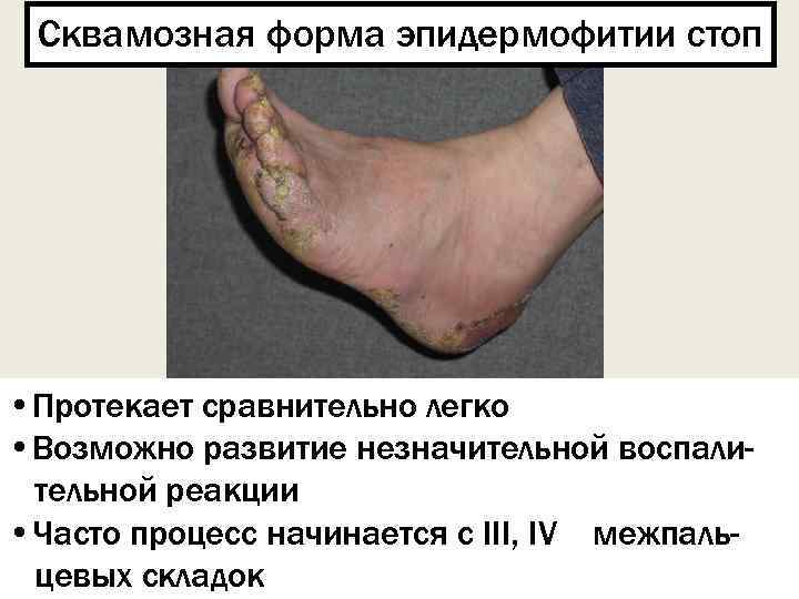 Сквамозная форма эпидермофитии стоп • Протекает сравнительно легко • Возможно развитие незначительной воспалительной реакции