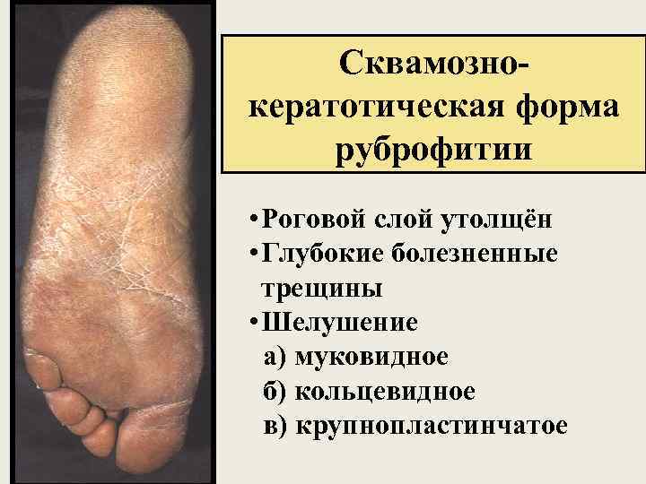 Сквамознокератотическая форма руброфитии • Роговой слой утолщён • Глубокие болезненные трещины • Шелушение а)