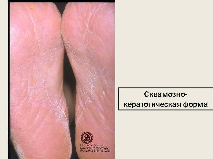 Сквамознокератотическая форма 