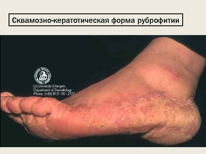 Сквамозно-кератотическая форма руброфитии 