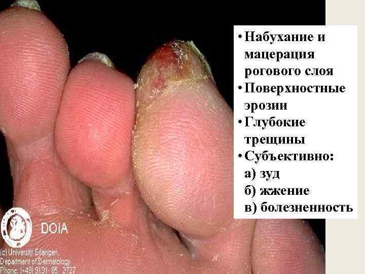  • Набухание и мацерация рогового слоя • Поверхностные эрозии • Глубокие трещины •