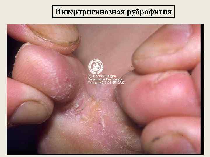 Интертригинозная руброфития 