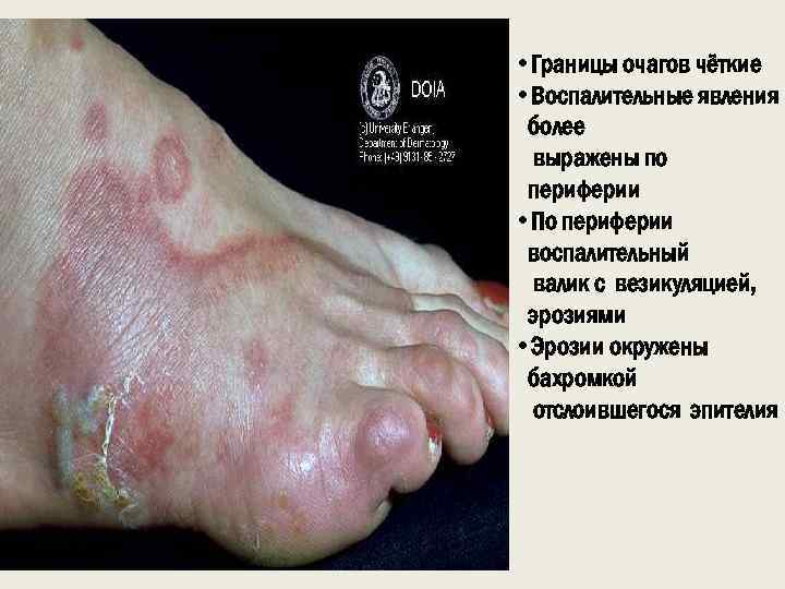  • Границы очагов чёткие • Воспалительные явления более выражены по периферии • По