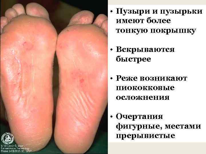  • Пузыри и пузырьки имеют более тонкую покрышку • Вскрываются быстрее • Реже