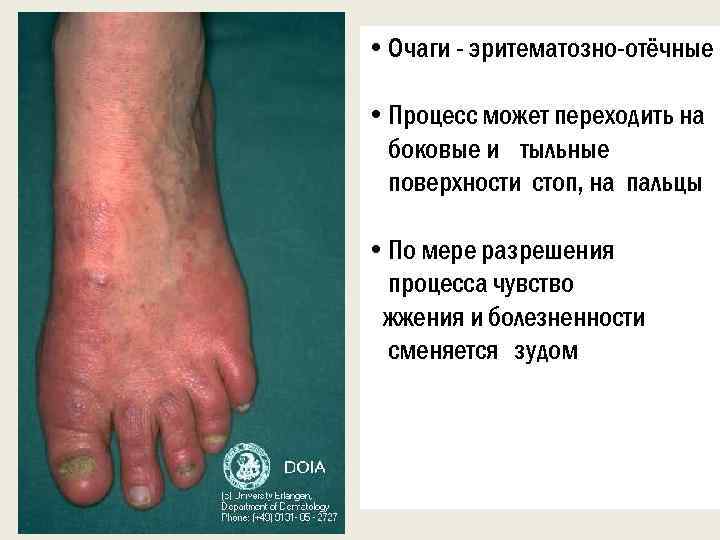  • Очаги - эритематозно-отёчные • Процесс может переходить на боковые и тыльные поверхности