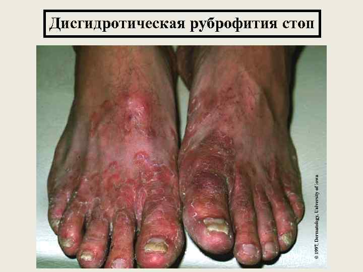 Дисгидротическая руброфития стоп 