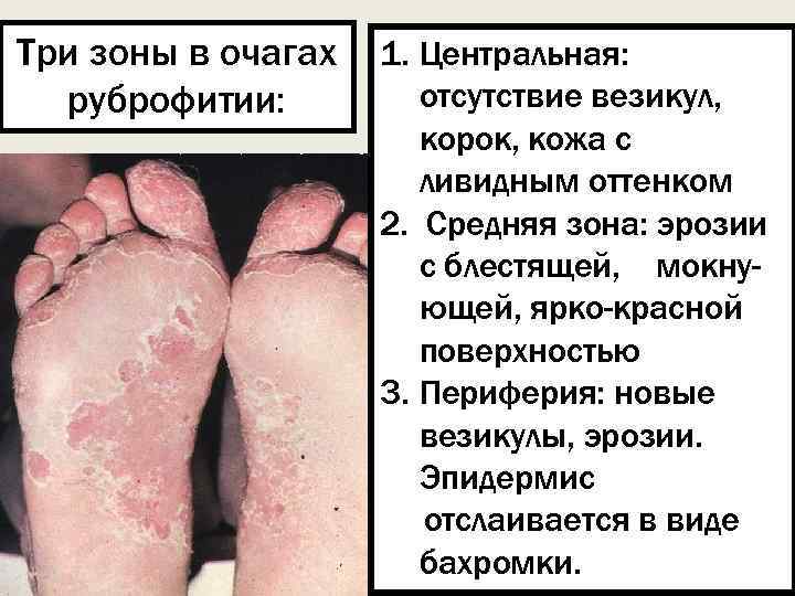 Три зоны в очагах руброфитии: 1. Центральная: отсутствие везикул, корок, кожа с ливидным оттенком