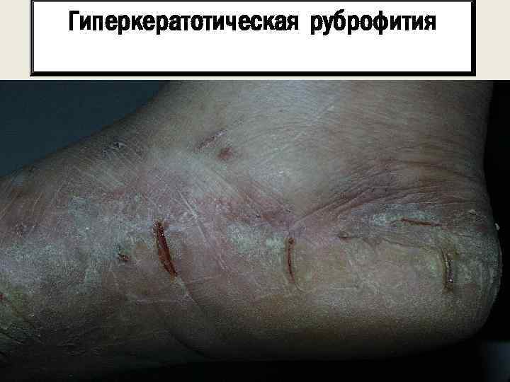 Гиперкератотическая руброфития 