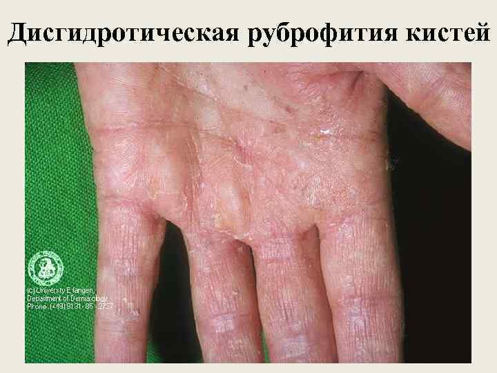 Дисгидротическая руброфития кистей 
