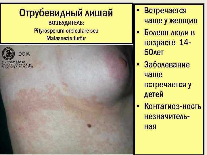 Отрубевидный лишай ВОЗБУДИТЕЛЬ: Pityrosporum orbiculare seu Malassezia furfur • Встречается чаще у женщин •
