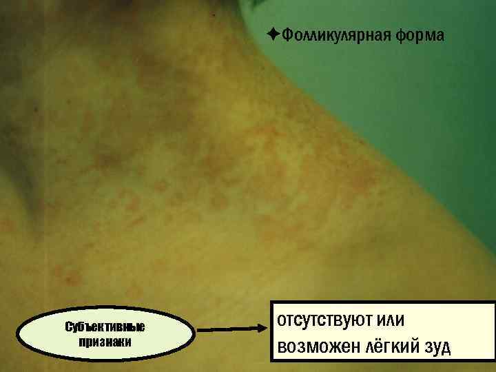 èФолликулярная форма Субъективные признаки отсутствуют или возможен лёгкий зуд 