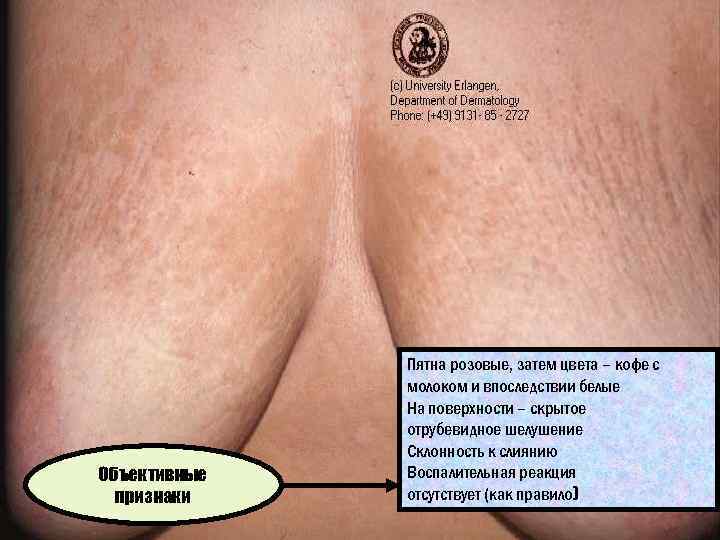 Объективные признаки Пятна розовые, затем цвета – кофе с молоком и впоследствии белые На