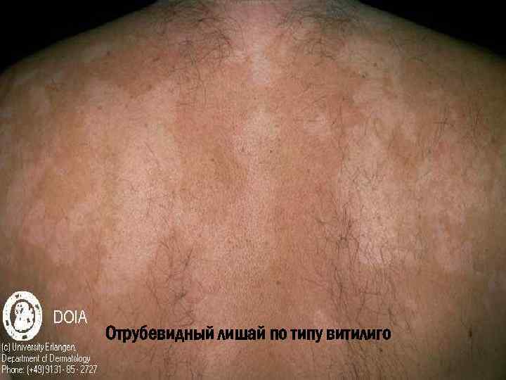 Отрубевидный лишай по типу витилиго 