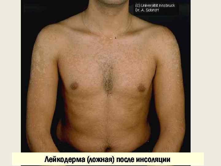 Лейкодерма (ложная) после инсоляции 