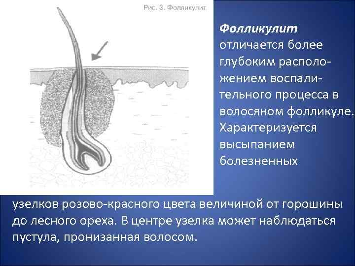 Фолликулит отличается более глубоким расположением воспалительного процесса в волосяном фолликуле. Характеризуется высыпанием болезненных узелков