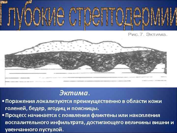  Эктима. • Поражения локализуются преимущественно в области кожи голеней, бедер, ягодиц и поясницы.