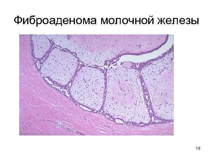 Фиброаденома молочной железы 16 