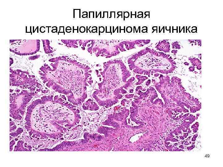 Папиллярная цистаденокарцинома яичника 49 