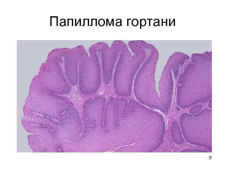 Папиллома гортани 6 