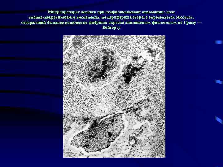 Микропрепарат легкого при стафилококковой пневмонии: очаг гнойно-некротического воспаления, по периферии которого определяется экссудат, содержащий