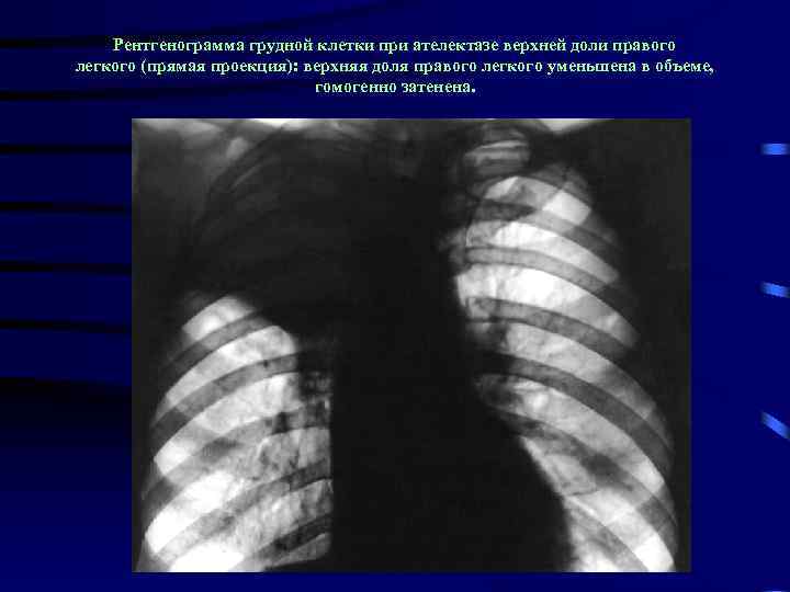 Рентгенограмма грудной клетки при ателектазе верхней доли правого легкого (прямая проекция): верхняя доля правого