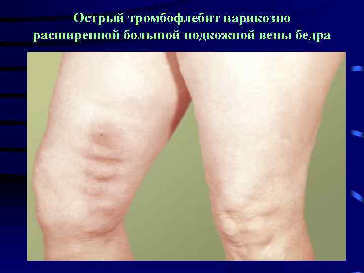 Острый тромбофлебит варикозно расширенной большой подкожной вены бедра 