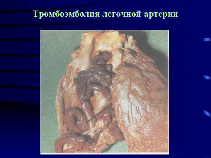 Тромбоэмболия легочной артерии 