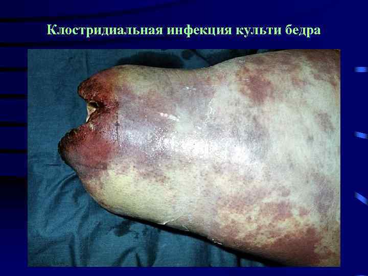 Клостридиальная инфекция культи бедра 