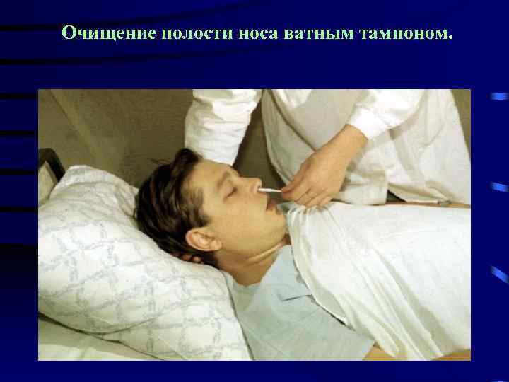 Очищение полости носа ватным тампоном. 