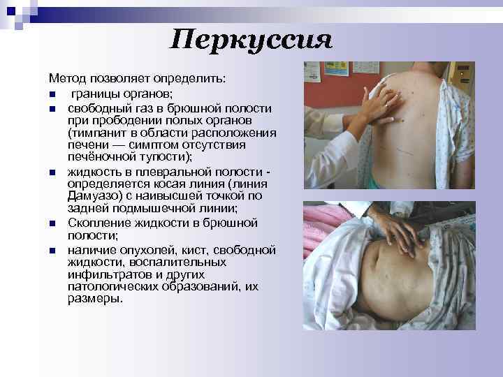 Перкуссия Метод позволяет определить: n границы органов; n свободный газ в брюшной полости прободении
