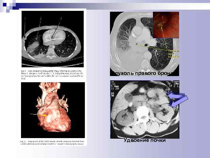 Опухоль правого бронха Удвоение почки 