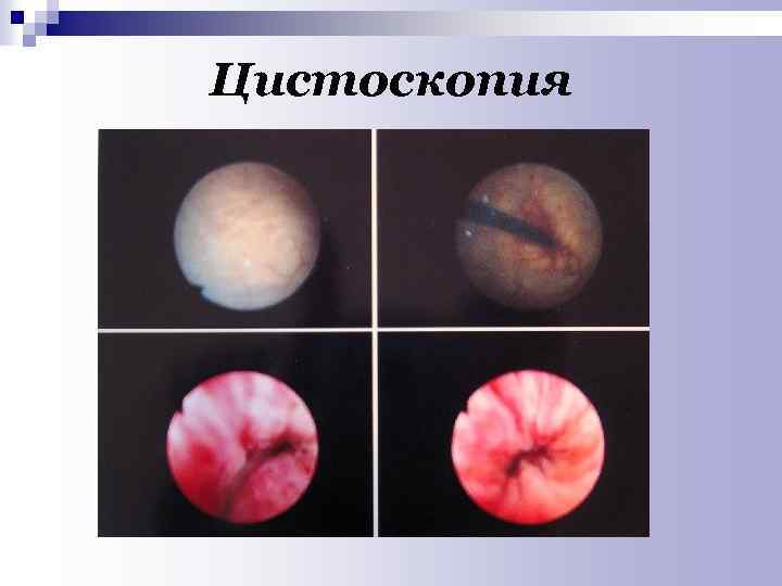 Цистоскопия 