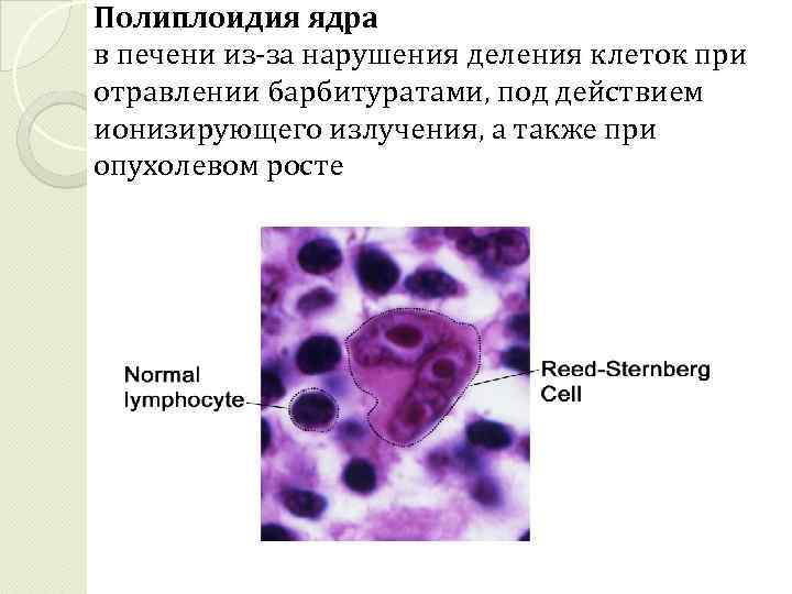 Полиплоидия ядра в печени из-за нарушения деления клеток при отравлении барбитуратами, под действием ионизирующего