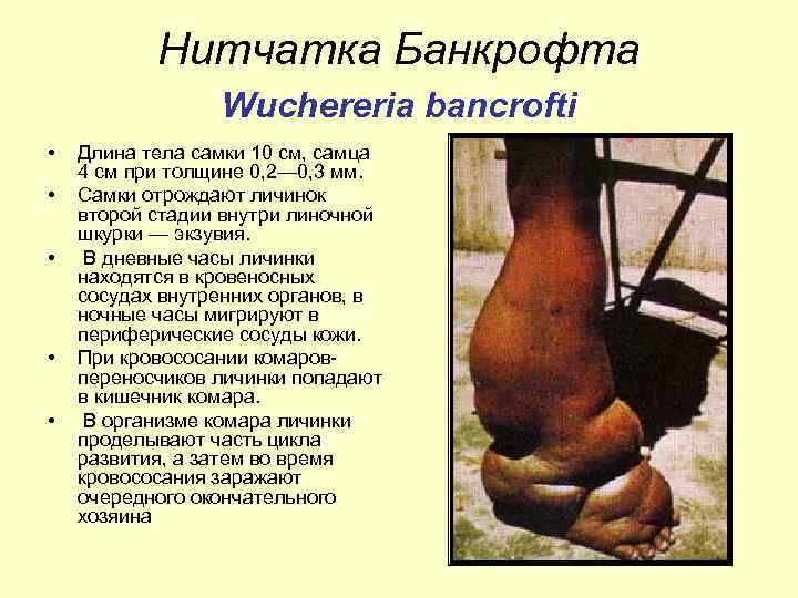 Нитчатка Банкрофта Wuchereria bancrofti • • • Длина тела самки 10 см, самца 4