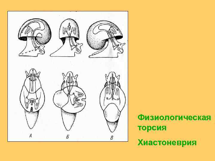 Физиологическая торсия Хиастоневрия 