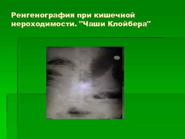 Ренгенография при кишечной нероходимости. 