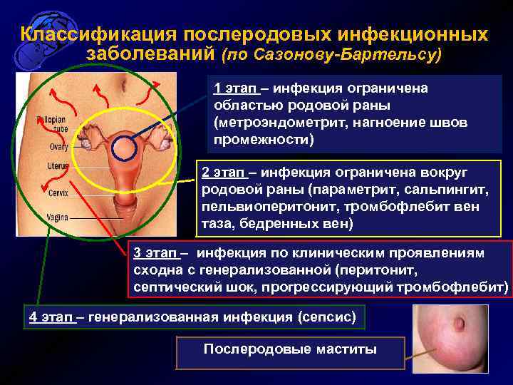 Классификация послеродовых инфекционных заболеваний (по Сазонову-Бартельсу) 1 этап – инфекция ограничена областью родовой раны