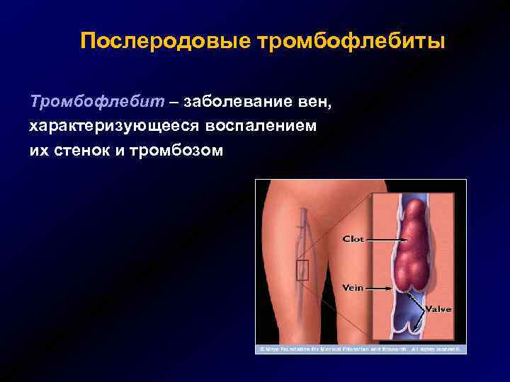 Послеродовые тромбофлебиты Тромбофлебит – заболевание вен, характеризующееся воспалением их стенок и тромбозом 